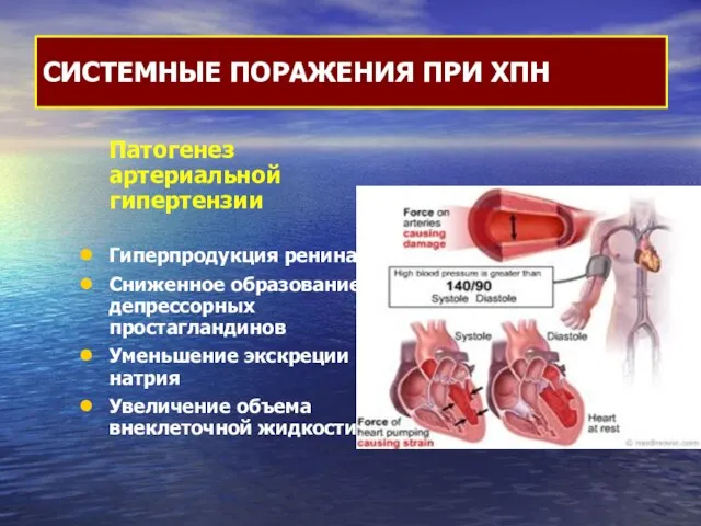 Патогенез артериальной гипертензии Гиперпродукция ренина Сниженное образование депрессорных простагландинов Уменьшение экскреции
