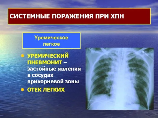 УРЕМИЧЕСКИЙ ПНЕВМОНИТ – застойные явления в сосудах прикорневой зоны ОТЕК ЛЕГКИХ