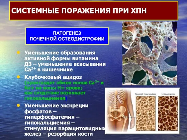 Уменьшение образования активной формы витамина Д3 – уменьшение всасывания Са2+ в