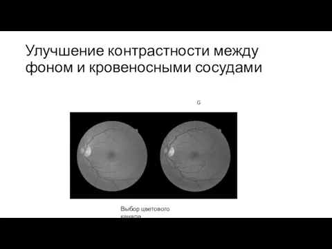 Улучшение контрастности между фоном и кровеносными сосудами G Выбор цветового канала