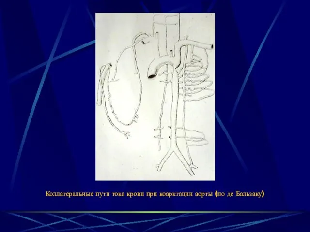 Коллатеральные пути тока крови при коарктации аорты (по де Бальзаку)