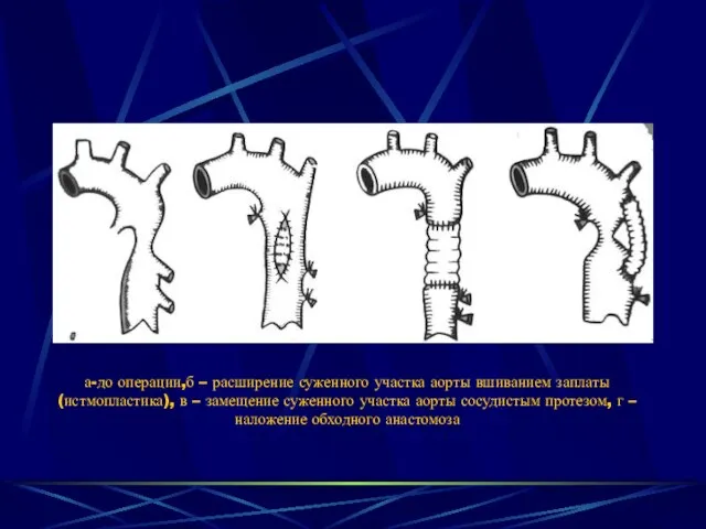 а-до операции,б – расширение суженного участка аорты вшиванием заплаты (истмопластика), в