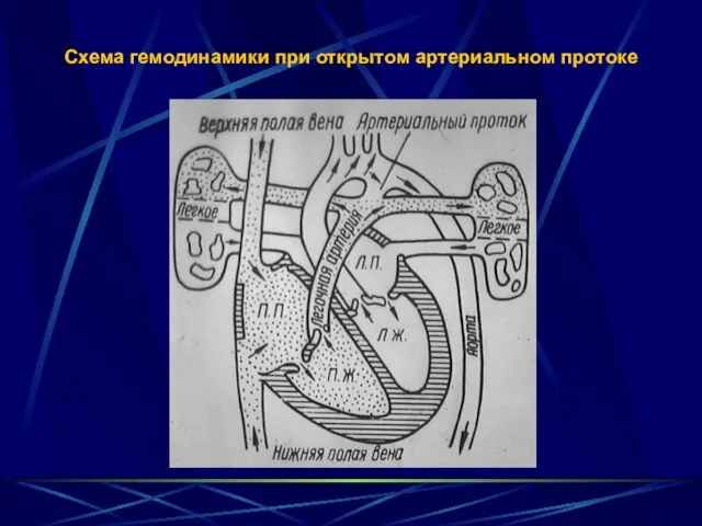 Схема гемодинамики при открытом артериальном протоке