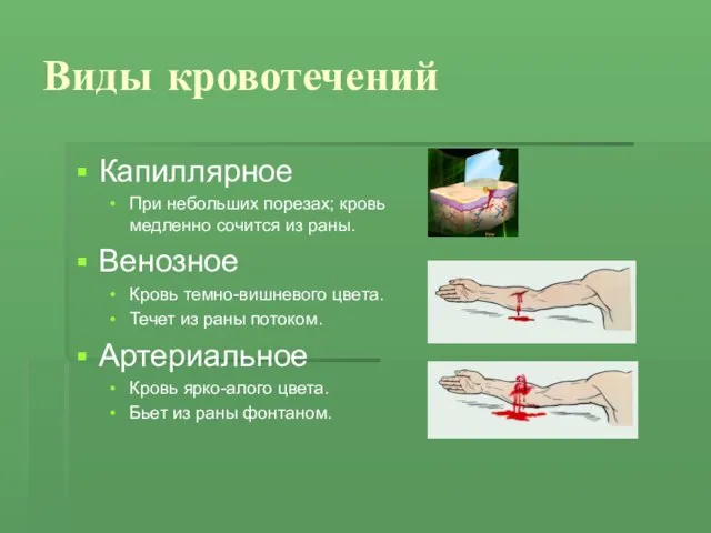 Виды кровотечений Капиллярное При небольших порезах; кровь медленно сочится из раны.