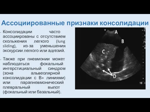 Ассоциированные признаки консолидации Консолидации часто ассоциированы с отсутствием скольжения легкого (lung