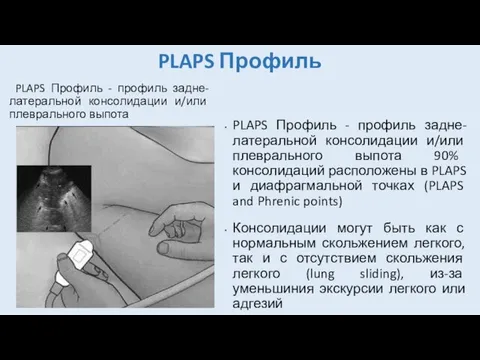 PLAPS Профиль PLAPS Профиль - профиль задне-латеральной консолидации и/или плеврального выпота