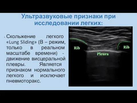 Ультразвуковые признаки при исследовании легких: Скольжение легкого «Lung Sliding» (В –