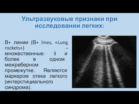 Ультразвуковые признаки при исследовании легких: В+ линии (В+ lines, «Lung rockets»)