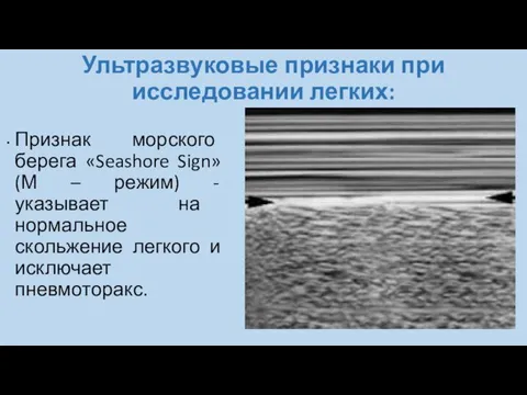 Ультразвуковые признаки при исследовании легких: Признак морского берега «Seashore Sign» (М