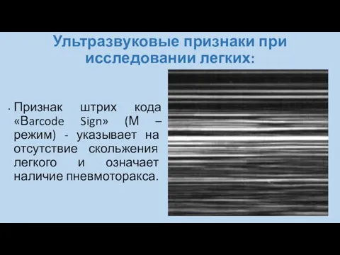 Ультразвуковые признаки при исследовании легких: Признак штрих кода «Вarcode Sign» (М