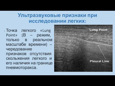 Ультразвуковые признаки при исследовании легких: Точка легкого «Lung Point» (В –