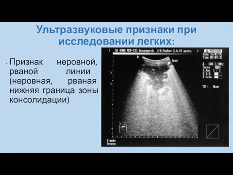 Ультразвуковые признаки при исследовании легких: Признак неровной, рваной линии (неровная, рваная нижняя граница зоны консолидации)