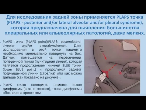 Для исследования задней зоны применяется PLAPS точка (PLAPS - posterior and/or