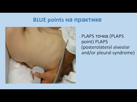 BLUE points на практике PLAPS точка (PLAPS point) PLAPS (posterolateral alveolar and/or pleural syndrome)