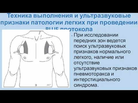 Техника выполнения и ультразвуковые признаки патологии легких при проведении BLUE протокола