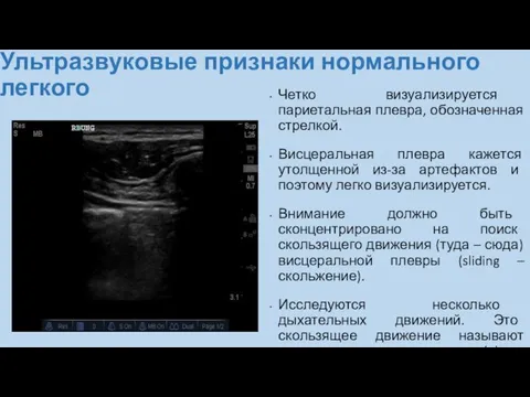 Ультразвуковые признаки нормального легкого Четко визуализируется париетальная плевра, обозначенная стрелкой. Висцеральная