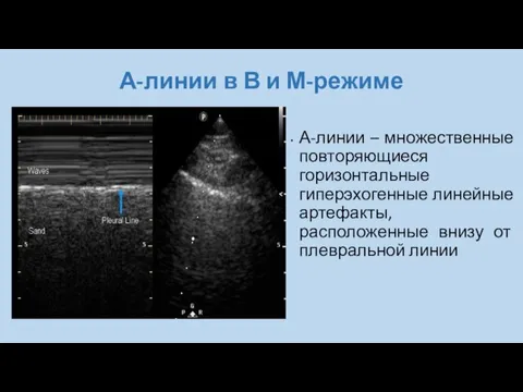 А-линии в В и М-режиме А-линии – множественные повторяющиеся горизонтальные гиперэхогенные