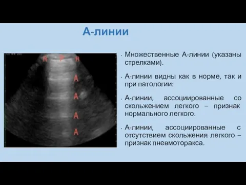 А-линии Множественные А-линии (указаны стрелками). А-линии видны как в норме, так