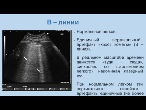 В – линии Нормальное легкое. Единичный вертикальный артефакт «хвост кометы» (В