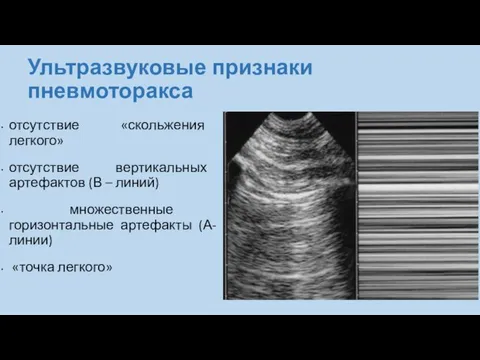 Ультразвуковые признаки пневмоторакса отсутствие «скольжения легкого» отсутствие вертикальных артефактов (В –