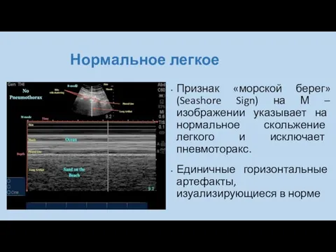 Нормальное легкое Признак «морской берег» (Seashore Sign) на М – изображении