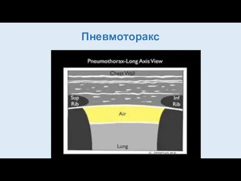 Пневмоторакс