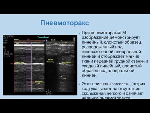 Пневмоторакс При пневмотораксе М – изображение демонстрирует линейный, слоистый образец, расположенный