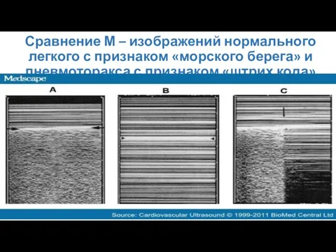 Сравнение М – изображений нормального легкого с признаком «морского берега» и пневмоторакса с признаком «штрих кода»