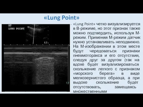 «Lung Point» «Lung Point» четко визуализируется в В-режиме, но этот признак