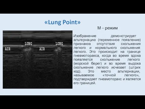 «Lung Point» М – режим Изображение демонстрирует альтернацию (переменное появление) признаков