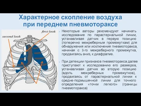 Характерное скопление воздуха при переднем пневмотораксе Некоторые авторы рекомендуют начинать исследование