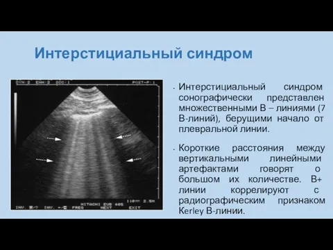 Интерстициальный синдром Интерстициальный синдром сонографически представлен множественными В – линиями (7