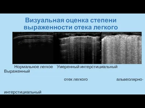 Визуальная оценка степени выраженности отека легкого Нормальное легкое Умеренный интерстициальный Выраженный