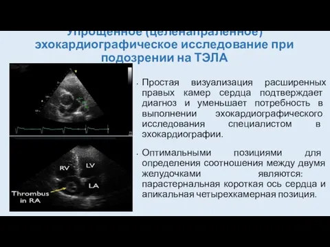 Упрощенное (целенапраленное) эхокардиографическое исследование при подозрении на ТЭЛА Простая визуализация расширенных