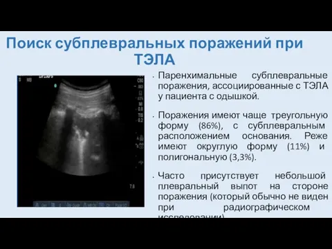 Поиск субплевральных поражений при ТЭЛА Паренхимальные субплевральные поражения, ассоциированные с ТЭЛА