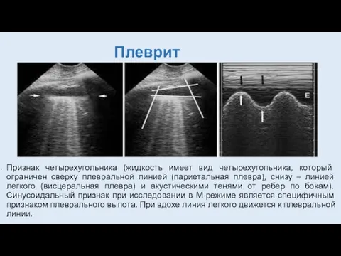 Плеврит Признак четырехугольника (жидкость имеет вид четырехугольника, который ограничен сверху плевральной