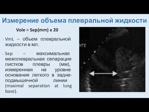 Измерение объема плевральной жидкости Vole = Sep(mm) x 20 VmL –