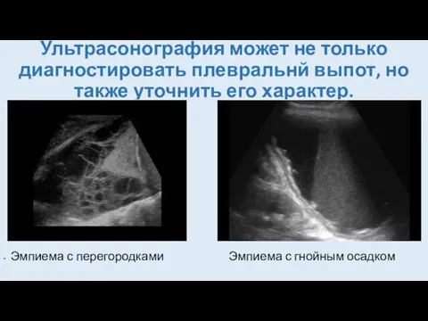 Ультрасонография может не только диагностировать плевральнй выпот, но также уточнить его