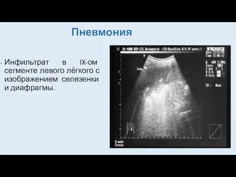 Пневмония Инфильтрат в IX-ом сегменте левого лёгкого с изображением селезенки и диафрагмы.