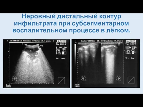 Неровный дистальный контур инфильтрата при субсегментарном воспалительном процессе в лёгком.