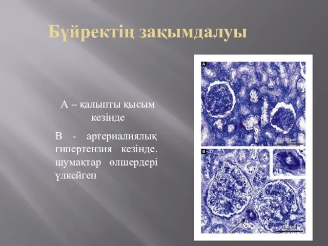 Бүйректің зақымдалуы А – қалыпты қысым кезінде В - артериалиялық гипертензия кезінде. шумақтар өлшердері үлкейген