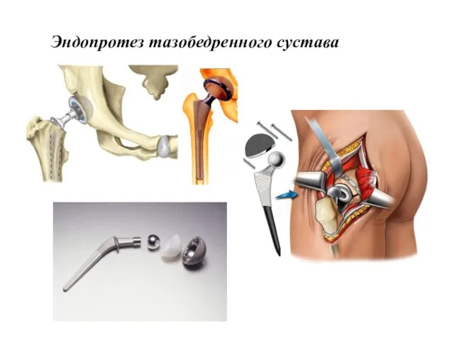 Эндопротез тазобедренного сустава