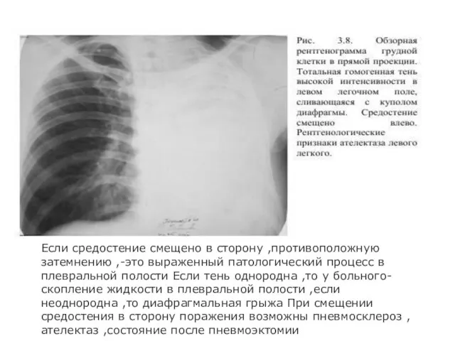 Если средостение смещено в сторону ,противоположную затемнению ,-это выраженный патологический процесс