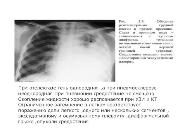 При ателектазе тень однородная ,а при пневмосклерозе неоднородная При пневмонии средостение