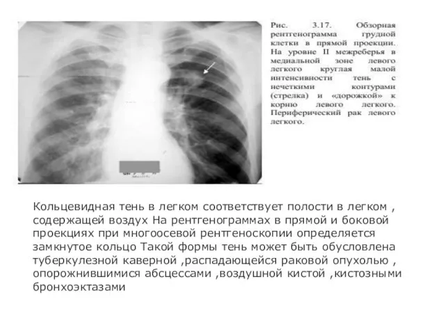 Кольцевидная тень в легком соответствует полости в легком ,содержащей воздух На