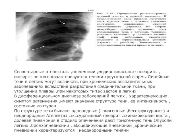 Сегментарные ателектазы ,пневмонии ,медиастинальные плевриты ,инфаркт легкого характеризуются тенями треугольной формы