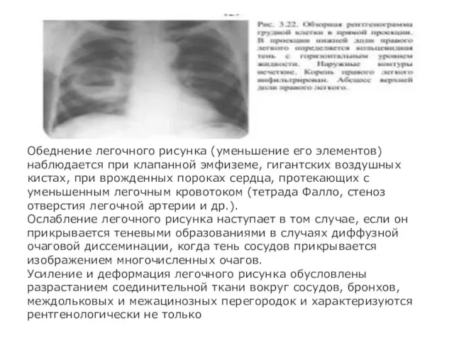 Обеднение легочного рисунка (уменьшение его элементов) наблюдается при клапанной эмфиземе, гигантских