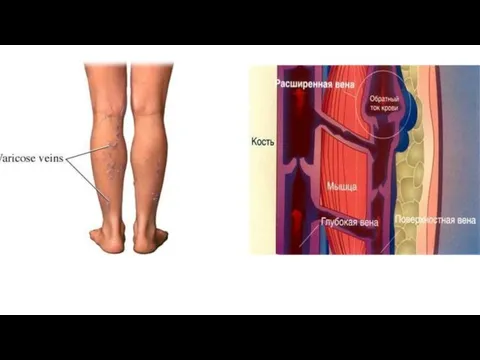 Варикозное расширение вен