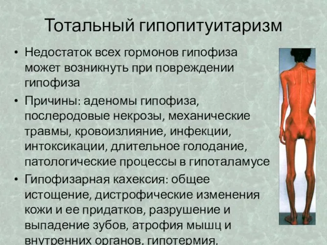 Тотальный гипопитуитаризм Недостаток всех гормонов гипофиза может возникнуть при повреждении гипофиза