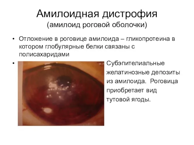 Амилоидная дистрофия (амилоид роговой оболочки) Отложение в роговице амилоида – гликопротеина